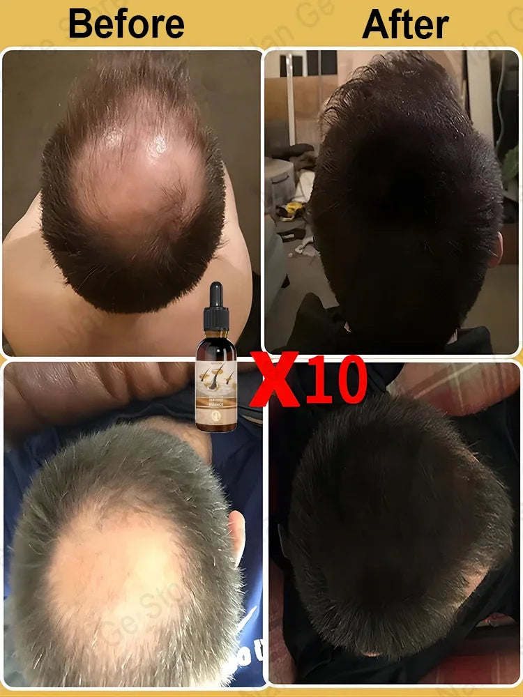 Unisex Hair Growth Oil Hair Loss Treatment Rapid Hair Growth Effective Baldness Repair Hereditary Postpartum Hair Loss