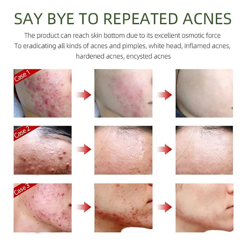 Salicylic Acne Face Moisturizing Gel Pimple Blackhead Removal Treatment