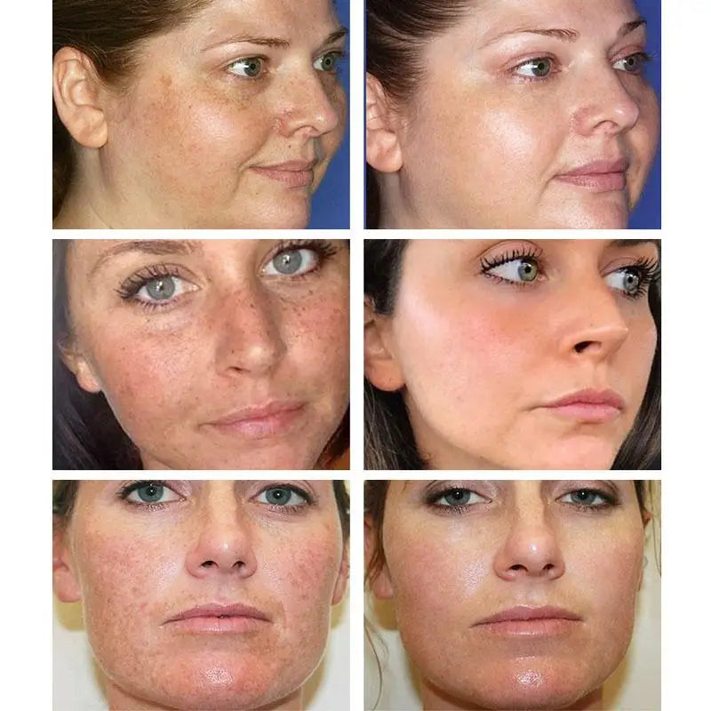 Dark Spots Freckle Melasma Corrector